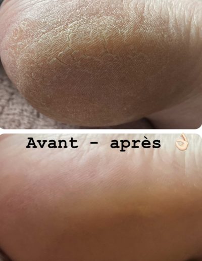 Talon poncé pied