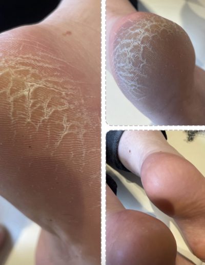 Exfoliation pied